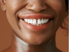 Close-up de um sorriso radiante de uma mulher, destacando um diastema evidente entre os dois dentes frontais superiores. A imagem sugere a possibilidade de utilizar um aparelho ortodôntico para ajustar o espaçamento e promover um alinhamento ideal dos dentes.