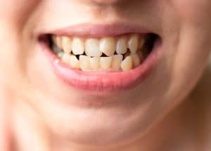  Close-up do sorriso de uma pessoa com dentes visivelmente tortos, destacando a necessidade de correção através de um aparelho ortodôntico para alinhar os dentes e melhorar a funcionalidade e estética do sorriso.