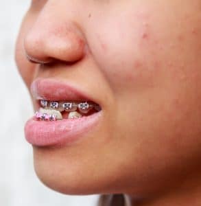 Close-up do sorriso de uma jovem que mostra um aparelho ortodôntico. A imagem destaca uma desproporção no tamanho da mandíbula, indicando a necessidade de tratamento ortodôntico para ajustar o alinhamento e melhorar a função mastigatória e estética do sorriso.