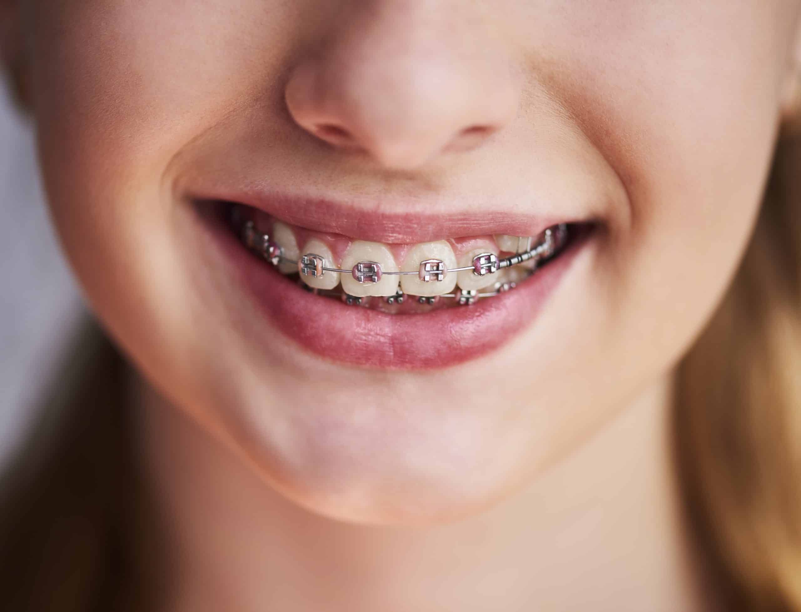 Close-up de um sorriso de uma criança mostrando dentes com aparelho ortodôntico metálico. O aparelho é decorado com elásticos coloridos, adicionando um elemento lúdico ao tratamento ortodôntico necessário para alinhar seus dentes e melhorar sua oclusão dental.