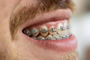 A imagem exibe um close-up do sorriso de um homem com aparelho ortodôntico autoligado. Os bráquetes metálicos são conectados por um arco, caracterizando este tipo de aparelho que dispensa o uso de elásticos. Visível também é parte de sua barba e bigode, complementando a imagem que foca na região bucal e no aparelho.