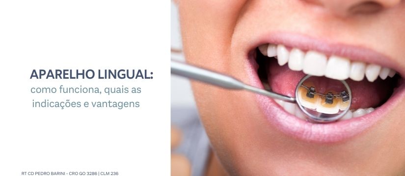 Você conhece o aparelho lingual? Venha sorrir com a barini odontologia