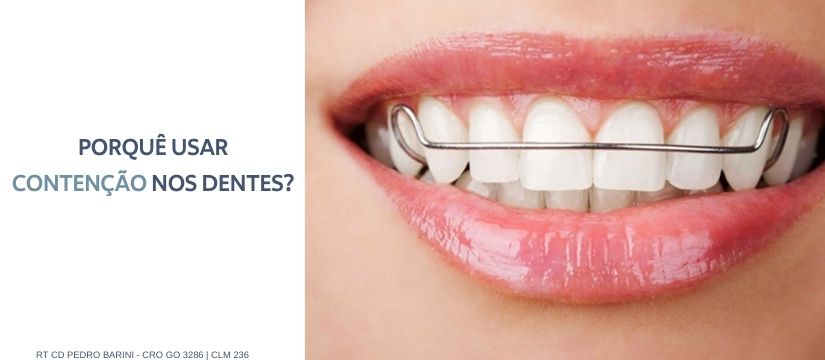 back Maryanne Jones protest Contenção de dente: o que é e quando usar | Barini Odontologia