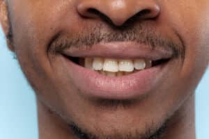 A imagem mostra um close-up do sorriso de um homem, destacando uma mordida cruzada anterior. Nesta condição, os dentes superiores não se alinham corretamente com os inferiores, com os dentes superiores estando posicionados atrás dos inferiores quando a boca está fechada. A foto é detalhada, mostrando os dentes superiores levemente recuados em relação aos inferiores. O homem tem uma pele morena e barba rala, e o foco está na sua expressão tranquila e no alinhamento dentário. O fundo é azul, proporcionando um contraste suave que realça o sorriso e as características faciais.