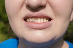 close-up da boca de uma mulher com uma condição de mordida cruzada posterior unilateral. Nela, os dentes superiores encobrem os dentes inferiores em um lado da arcada. Esta condição é evidente no lado esquerdo, onde os dentes superiores estão mais avançados em relação aos inferiores, enquanto o lado direito parece ter um alinhamento normal. A foto, capturada ao ar livre, destaca a desigualdade no alinhamento dentário e a expressão neutra da mulher.