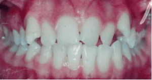 Ortodontia antes e depois: Visão frontal dos dentes com leve desalinh

amento antes de iniciar o tratamento ortodôntico, destacando a condição inicial dos dentes.