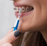 Ortodontia antes e depois: Pessoa utilizando uma escova interdental para limpar entre os bráquetes e os fios de um aparelho ortodôntico