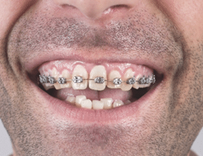 Ortodontia antes e depois: Adulto sorrindo enquanto usa um aparelho ortodôntico metálico. 