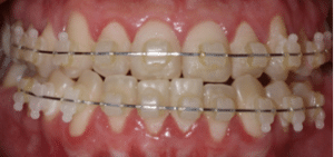 Ortodontia antes e depois: Visão frontal de dentes com aparelho ortodôntico estético, menos visível que os metálicos.