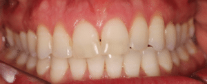 Ortodontia antes e depois: Visão frontal dos dentes perfeitamente alinhados após o tratamento ortodôntico, destacando o resultado bem-sucedido e a eficácia do tratamento.