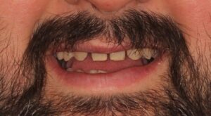 Boca de um homem com barba, exibindo dentes com espaços e aparência assimétrica.