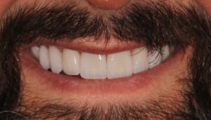 Sorriso de um homem com barba após tratamento estético, com dentes brancos, alinhados e sem espaços, resultado do uso de lentes de contato dental.