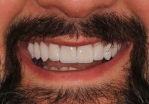 Sorriso de um homem com barba, mostrando dentes alinhados e brancos graças à aplicação de lentes de contato dental.
