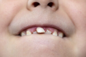 Sorriso infantil com dente de leite ausente, indicando fase de dentição mista. 
